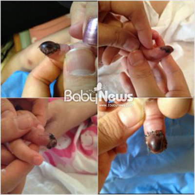 사진은 아이가 3시간여의 봉합수술을 하고 난 다음의 손가락 모습. ⓒ네이트판