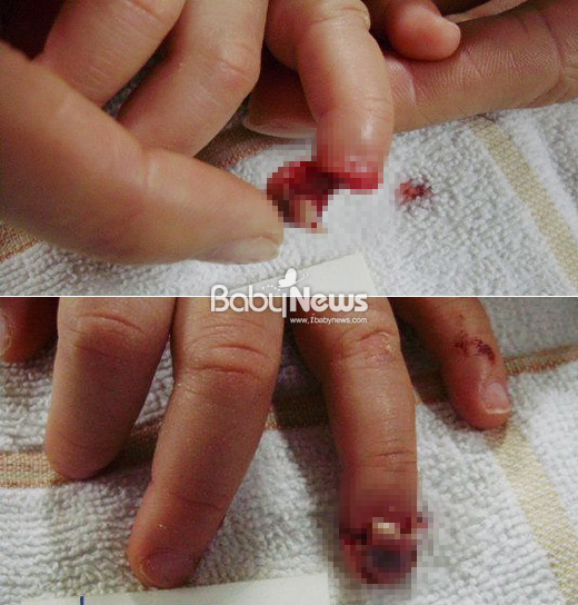 지난 2011년 2월 서울 관악구 한 아파트 단지 내 가정어린이집 베란다 문에 20개월 된 여자 아기의 손가락이 끼어 절단되는 사고가 발생했다. 이 사진은 피해아동의 어머니가 제공해왔다.