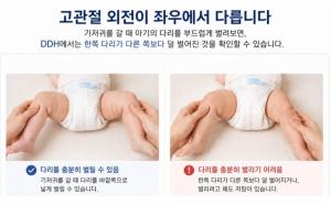 [임신영 칼럼] 아기의 다리가 잘 벌어지지 않는데 괜찮을까요?